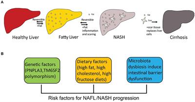 Non-alcoholic Steatohepatitis Pathogenesis, Diagnosis, and Treatment